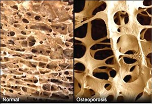 正常骨和骨質疏鬆骨的對比