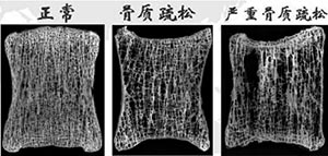 缺鈣骨質疏鬆和正常骨對比