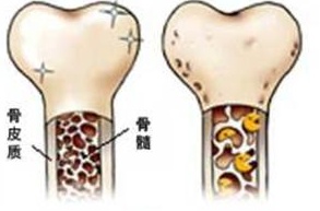 正常的骨頭和病變的骨頭