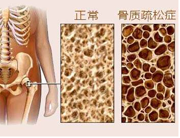 麻豆激情床戏视频儀是檢測麻豆激情床戏视频T值得，麻豆激情床戏视频又決定骨質疏鬆的重要指標