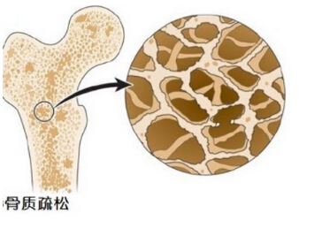 麻豆激情床戏视频儀提示骨質疏鬆並非是老年人的“專利”五宜五忌不要掉以輕心