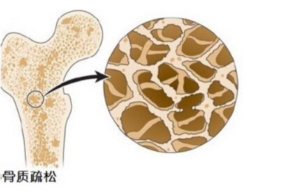 麻豆激情床戏视频檢測儀闡述多吃醋會讓骨鈣溶出而流失造成骨質疏鬆