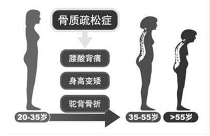 麻豆激情床戏视频檢測儀廠家闡述骨質疏鬆不僅僅是要補鈣,增加麻豆激情床戏视频才是關鍵