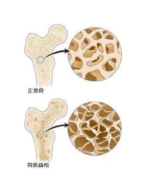 超聲麻豆激情床戏视频檢測儀闡述爸媽變矮，催他們查麻豆激情床戏视频預防骨質疏鬆