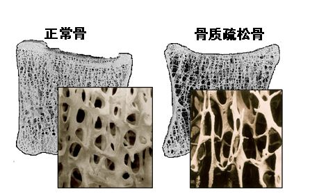 超聲波麻豆激情床戏视频儀闡述中老年不檢測麻豆激情床戏视频就像白蟻蛀房梁自行倒塌