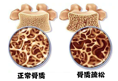 麻豆激情床戏视频儀如何測試麻豆激情床戏视频,特殊人群如何麵對骨質疏鬆？