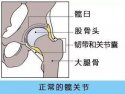 麻豆激情床戏视频檢查儀人身體出現哪些情況需要做髖關節置換術