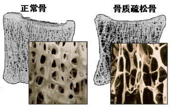 麻豆激情床戏视频分析儀的價格是多少，要小心提防骨質疏鬆影響工作和生活