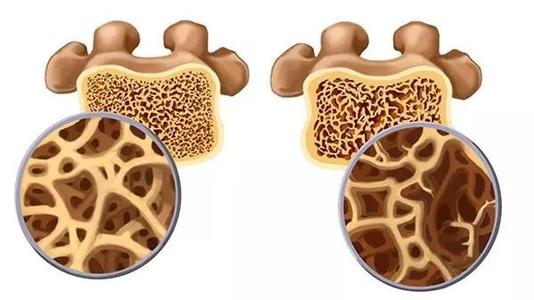 超聲麻豆激情床戏视频測定儀讓大家更好的了解骨骼情況該如何預防骨質疏鬆?